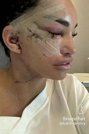 凯蒂·普莱斯展示了她最新的整容手术的戏剧性效果,她身上缠满了绷带